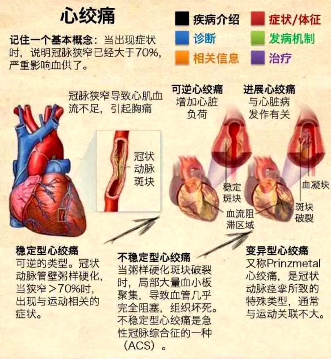 心绞痛的最早分型